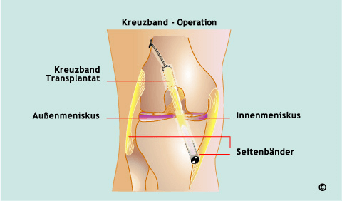 Farbiges medizinisches Diagramm eines Knies mit Beschriftungen zu Kreuzband-Operation, Kreuzband-Transplantat, Außenmeniskus, Innenmeniskus und Seitenbändern.