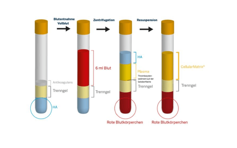 Vier Reagenzgläser mit gelbem Verschluss zeigen verschiedene Phasen der Blutverarbeitung: Vollblut, Zentrifugation mit Trennung in Plasma und rote Blutkörperchen, und Resuspension mit markierten Schichten und Beschriftungen.