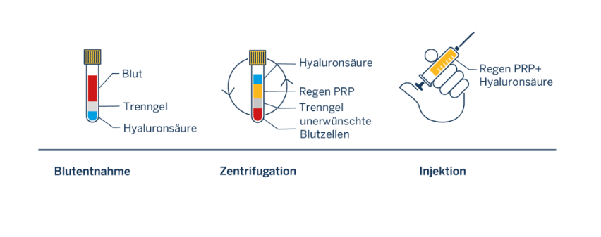 Drei schematische Darstellungen: Blutprobe im Röhrchen mit Trenngelee und Hyaluronsäure, Zentrifugation mit Schichtenblut und Beschriftungen, Hand mit Spritze, die PRP und Hyaluronsäure injiziert.